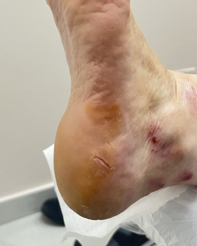 Lo stesso tallone levigato e idratato dopo il pedicure curativo