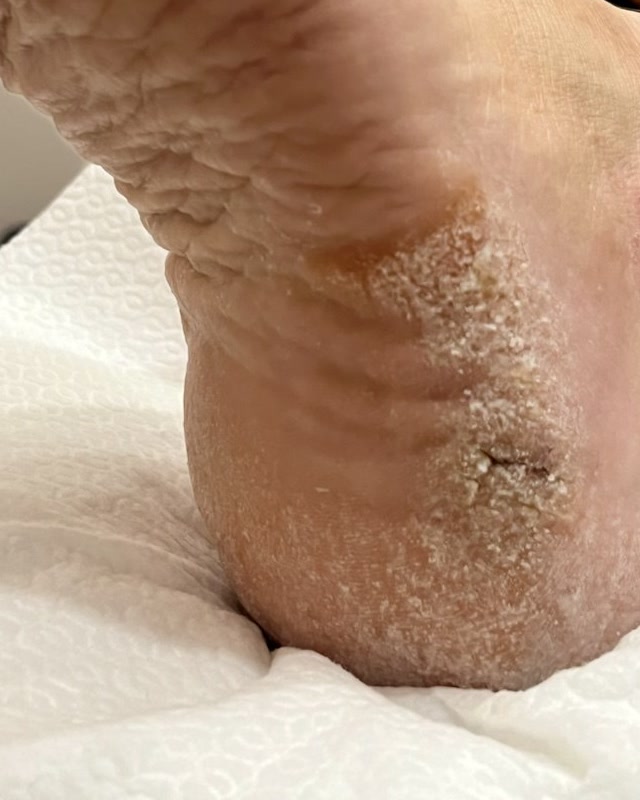 Tallone con ipercheratosi spessa e ragade, prima del pedicure curativo
